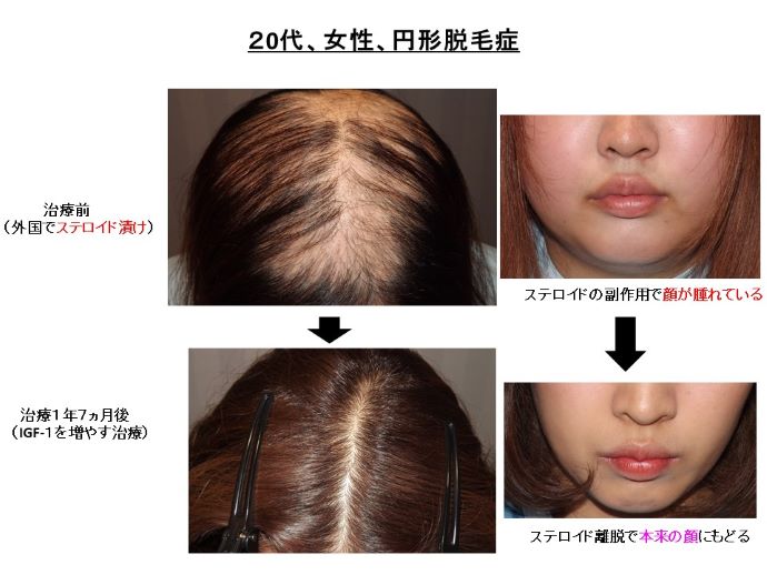 円形脱毛症　病院